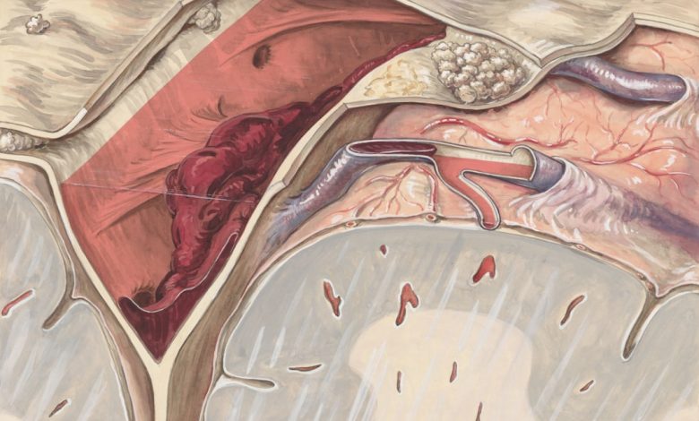 Cross-section of a brain showing a subdural hematoma.